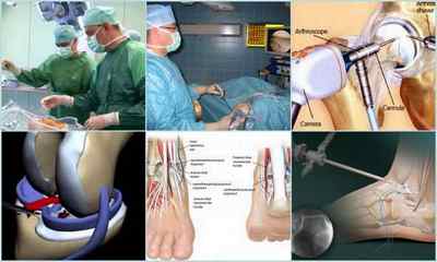 Артроскопія колінного, тазостегнового, гомілковостопного суглобів: що це таке, як проводиться діагностика і операція, ціна, протипоказання, реабілітація, відгуки