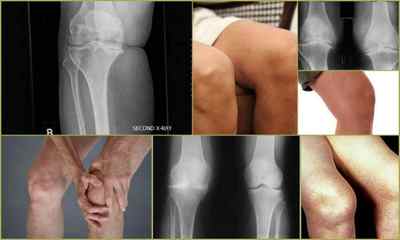 Артроз колінного суглоба 2 ступеня - симптоми і лікування