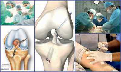 Артроз колінного суглоба 3 ступеня - симптоми і лікування без операції