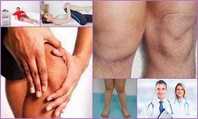 Артроз колінного суглоба: симптоми, лікування, причини, діагностика, фото, відгуки