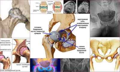 Артроз кульшового суглоба: симптоми, лікування, види, ступені, фото, причини, діагностика