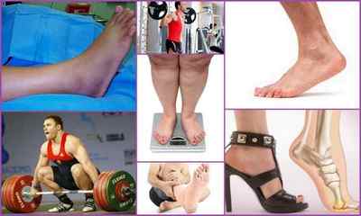 Артроз великого пальця ноги: лікування, симптоми, фото, відгуки