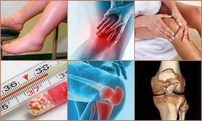 Артрозо-артрит гомілковостопного, колінного, тазостегнового суглобів, стопи: причини, симптоми, лікування