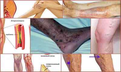 Атеросклероз судин нижніх кінцівок: симптоми і лікування, причини, діагностика, профілактика