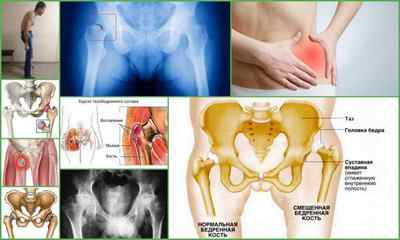 Біль в тазостегновому суглобі віддає в ногу і сідницю - причини і лікування
