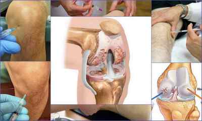 Блокада колінного суглоба при артрозі - препарати, опис процедури