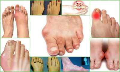 Болить суглоб великого пальця на нозі: причини і лікування