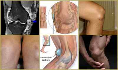 Бурсит гусячої лапки колінного суглоба: причини, симптоми, лікування