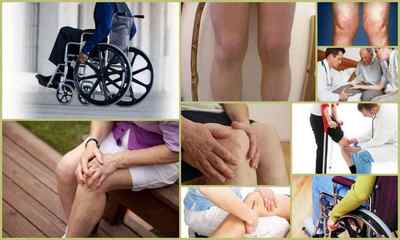 Чи дають інвалідність при артрозі (гонартрозе, остеоартрозі) суглобів: групи, ступеня, умови отримання