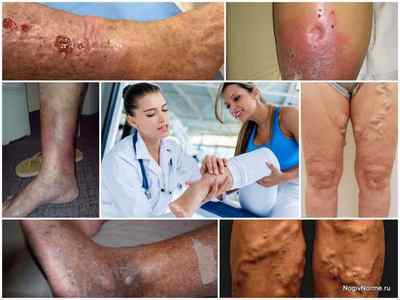 Чим небезпечний варикоз на ногах - наслідки і ускладнення у жінок і чоловіків