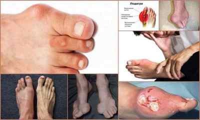 Чим і як лікувати подагру на великому пальці ноги