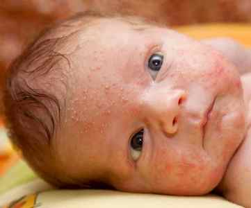 Діагностика та лікування алергії у новонароджених дітей