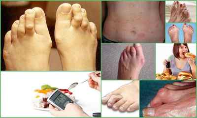 Деформація пальців ніг - види, симптоми, лікування