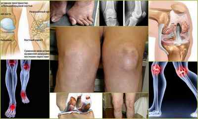 Деформуючий артрит: лікування колінного суглоба
