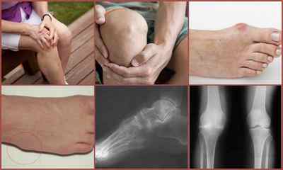 Диференціальна діагностика ревматоїдного артриту: хвороби, види досліджень, критерії