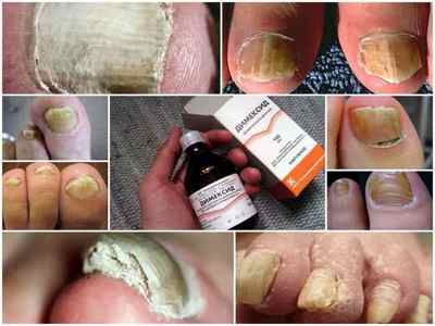 Димексид від грибка нігтів на ногах - інструкція із застосування, відгуки