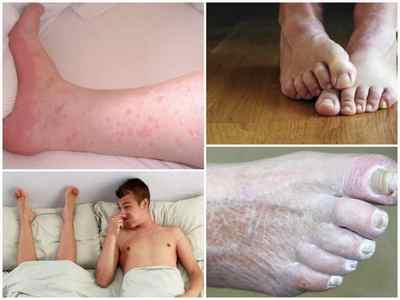 Димексид від грибка нігтів на ногах - інструкція із застосування, відгуки