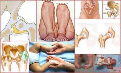 Дисплазія кульшового суглоба у дорослих: причини, симптоми, діагностика, лікування