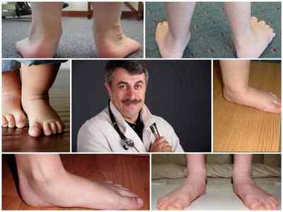 Доктор Комаровський про плоскостопості у дітей - причини і лікування