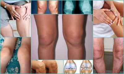 Двосторонній гонартроз колінних суглобів 123 ступеня - симптоми і лікування