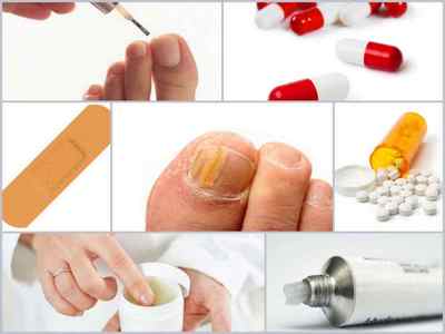 Ефективні засоби від грибка нігтів на ногах - огляд кращих препаратів