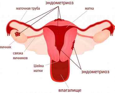 Ендометріоз після кесаревого розтину: причини і лікування