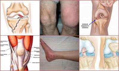 Гемартроз колінного суглоба - що це таке? симптоми, лікування, фото