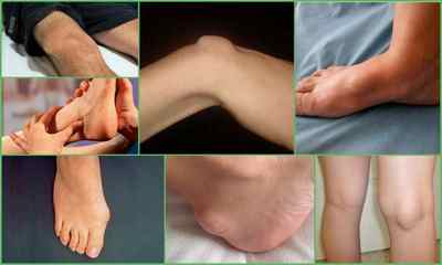 Гігрома на нозі (стопи і гомілки): фото, лікування