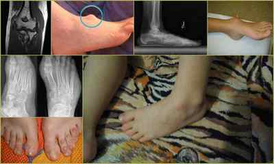 Гігрома на нозі у дитини: види, прчіни, симтомов, лікування