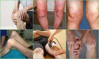 Гонартроз колінного суглоба: симптоми, лікування, ступеня, фото, причини, діагностика