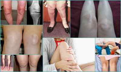 Гонартріт колінного суглоба 12 3 ступеня - симтомов і лікування