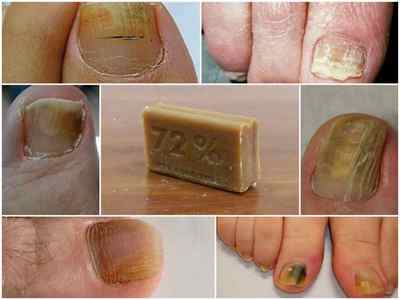 Господарське мило від грибка нігтів на ногах - народні рецепти та відгуки