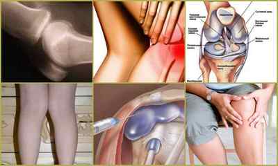 Гострий артроз колінного суглоба - симтомов і лікування