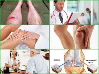 Ходьба на колінах при артрозі колінного суглоба: відгуки, користь і шкода методу