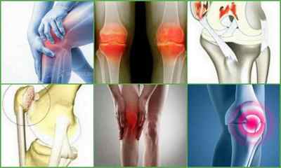 Хондромаляція надколінка і колінного суглоба: причини, симптоми, діагностика, лікування