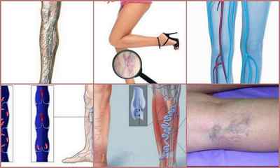 Хронічна венозна недостатність нижніх кінцівок: симптоми, лікування, ступеня, фото