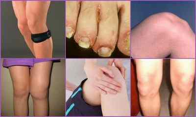 Хвороба Шляттера колінного суглоба у підлітків, дорослих і дітей - симптоми і лікування