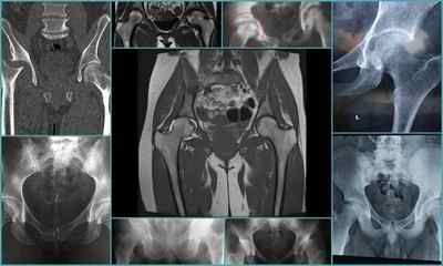 Хвороби тазостегнового суглоба: симптоми, фото, лікування (вправа, уколи, таблетки, мазі, види операцій)