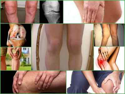 Коксартроз колінного суглоба - симптоми і лікування