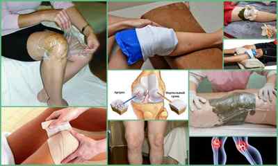 Компреси при артрозі колінного суглоба - народні рецепти, застосування