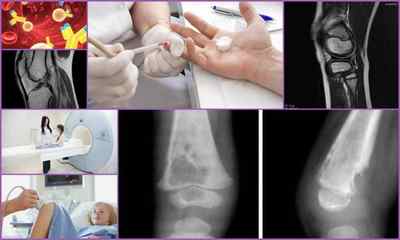 Контрактура колінного суглоба: види, причини, симптоми, лікування