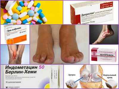 Кращі ліки від артрозу суглобів - препарати для лікування (таблетки, мазі, уколи)
