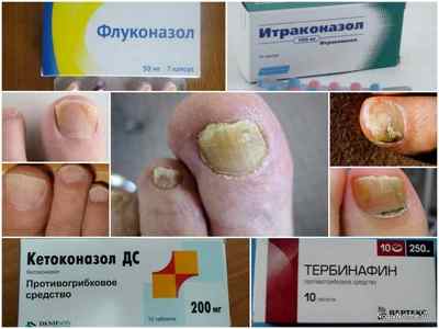 Кращі таблетки від грибка нігтів на ногах - список ефективних препаратів