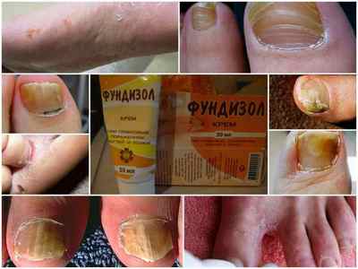 Крем Фундізол від грибка нігтів на ногах: інструкція із застосування, ціна, відгуки, аналоги