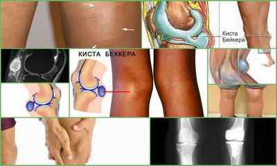 Кіста Бейкера колінного суглоба: причини, симптоми, фото, діагностика, лікування