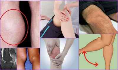 Кіста Бейкера колінного суглоба: причини, симптоми, фото, діагностика, лікування