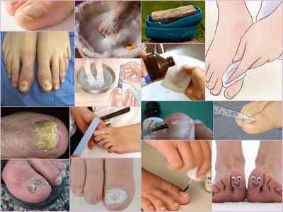 Лаки від грибка нігтів на ногах: ефективність, ціна, відгуки