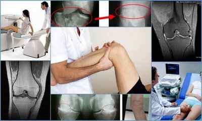 Лігаментоз колінного суглоба: що це таке, причини, симптоми, лікування