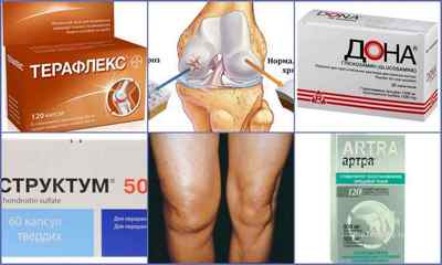 Ліки від артрозу колінного суглоба - препарати для медикаментозного лікування (таблетки, мазі, уколи)