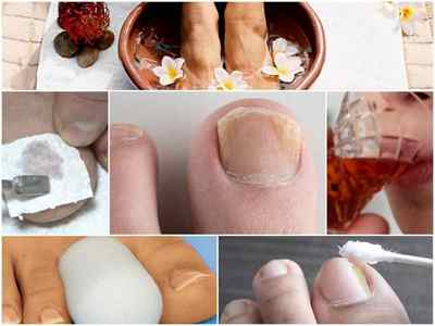 Лікування грибка нігтів на ногах народними засобами - найефективніші рецепти та відгуки